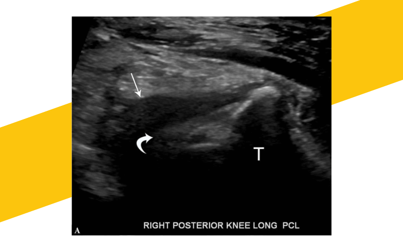 6. Evaluacion rodilla ecografia.png